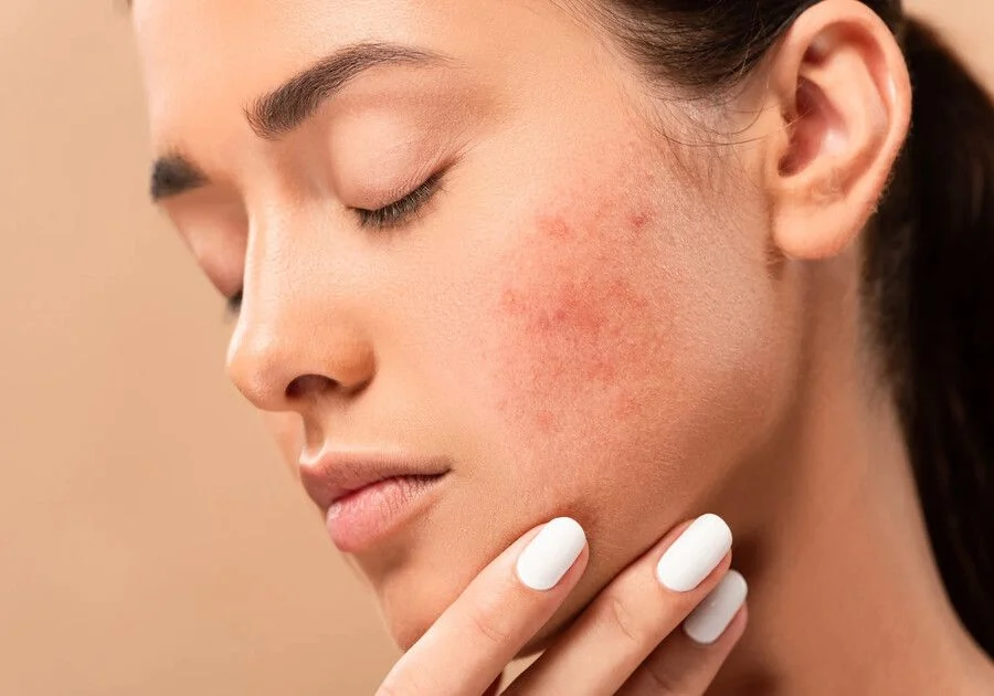 Trị phồng rộp da do cháy nắng