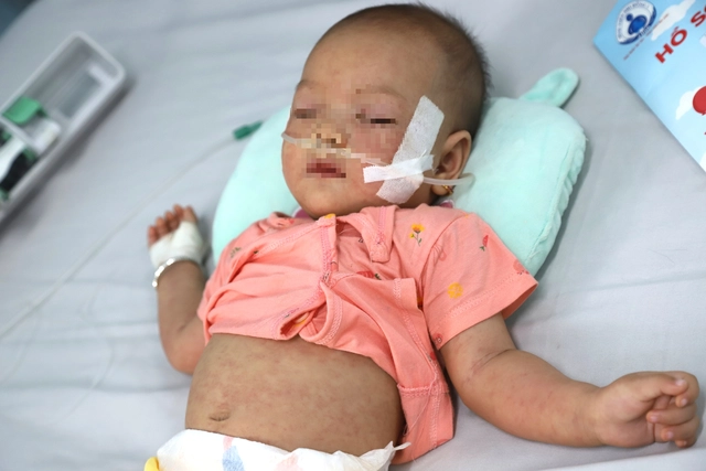 Bệnh tay chân miệng vào mùa, giải pháp nào ‘kìm hãm’?
