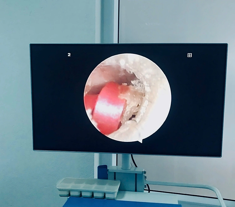 Sợi dây buộc tóc suýt gây thủng màng nhĩ bé gái