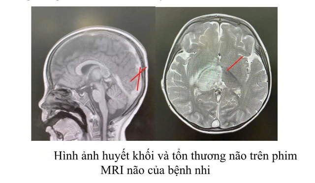 Cứu sống bé trai 2,5 tuổi bị huyết khối nội sọ do rối loạn chuyển hóa hiếm gặp