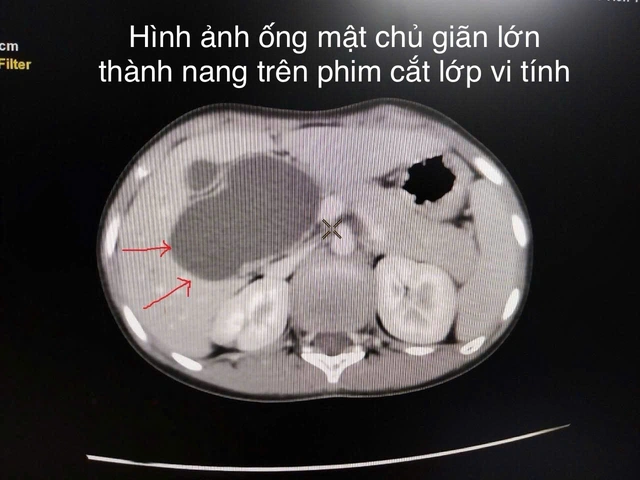 Bệnh viện Trẻ em Hải Phòng nội soi cắt nang ống mật chủ lớn cho bệnh nhi 10 tuổi