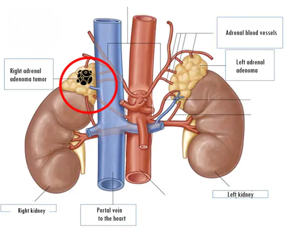 Suy tuyến thượng thận do lạm dụng thuốc điều trị bệnh gout