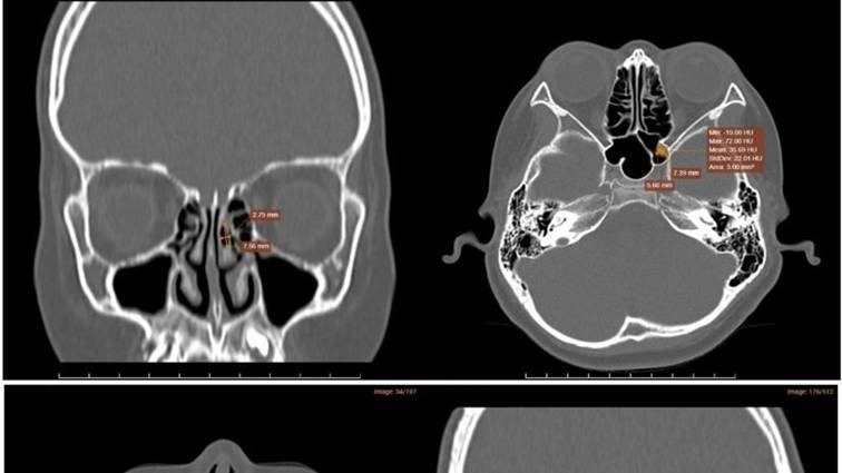CẢNH BÁO: Dị ứng mạt bụi nhà có thể khiến viêm xoang kéo dài