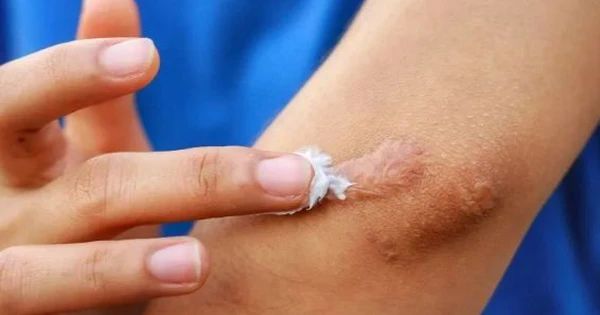 Bộ Y tế đình chỉ, thu hồi toàn quốc, yêu cầu tiêu huỷ 1 loại gel 'ngừa sẹo' do vi phạm 3 lỗi
