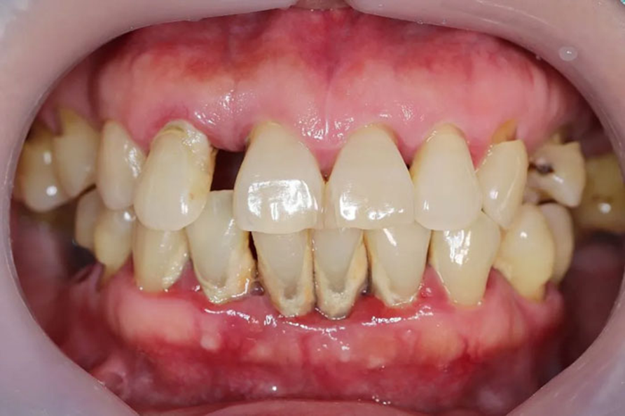 Viêm nha chu ở người cao tuổi: 'Rào cản' chất lượng cuộc sống
