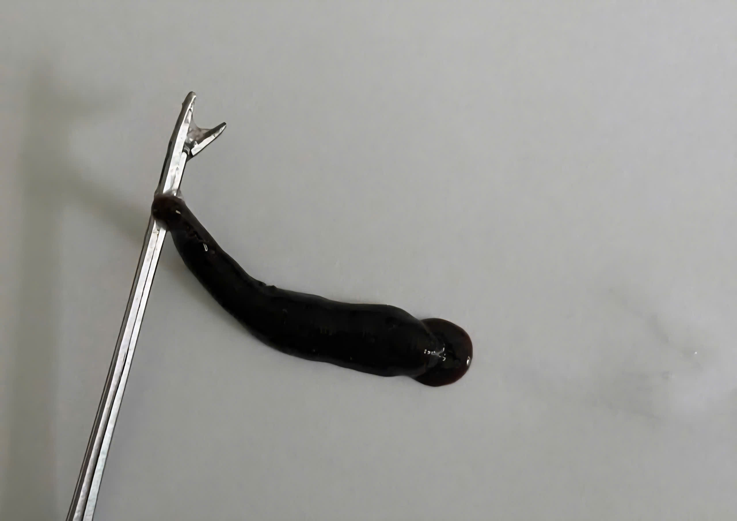 Đỉa dài 4cm ký sinh trong mũi bé trai suốt 10 ngày