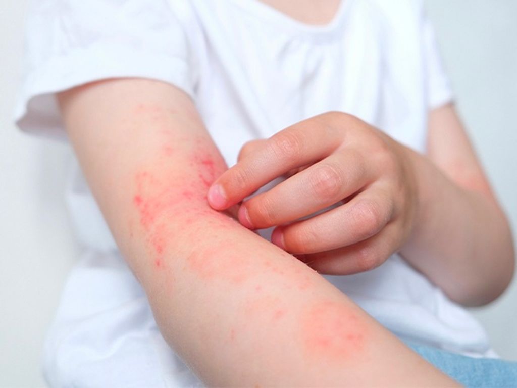 Các biện pháp phòng ngừa viêm da cơ địa