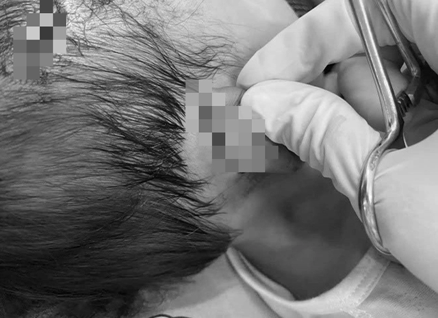 Bé gái 19 tháng tuổi bị chó dữ tấn công