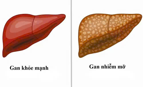 Người bị xơ gan, gan nhiễm mỡ do rượu bao lâu nên khám một lần?