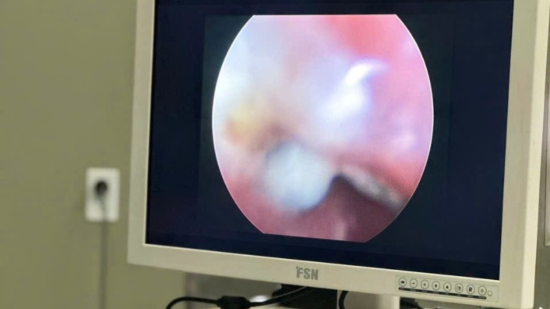 Cà Mau: Cứu sống 2 bệnh nhi nuốt dị vật nguy hiểm Cà Mau: Cứu sống 2 bệnh nhi nuốt dị vật nguy hiểm