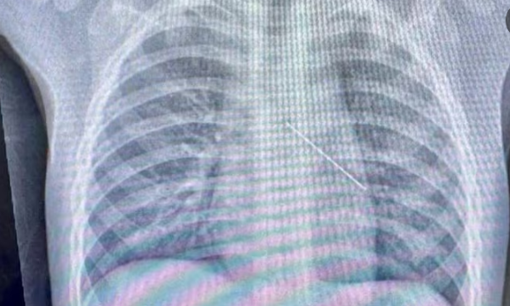 Cảnh báo tai nạn nguy hiểm do dị vật gây ra ở người lớn tuổi và trẻ nhỏ