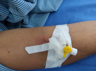 GÃY ỐNG THÔNG TĨNH MẠCH NGOẠI VI DO CẮT VÔ TÌNH BẰNG KÉO: BÀI HỌC TỪ HAI CA BỆNH VÀ TẦM QUAN TRỌNG CỦA PHẢN ỨNG LÂM SÀNG NGAY LẬP TỨC