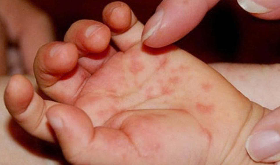 Gần 25.000 ca mắc tay chân miệng, tăng gấp 5 lần: Bộ Y tế chỉ đạo khẩn Gần 25.000 ca mắc tay chân miệng, tăng gấp 5 lần: Bộ Y tế chỉ đạo khẩn