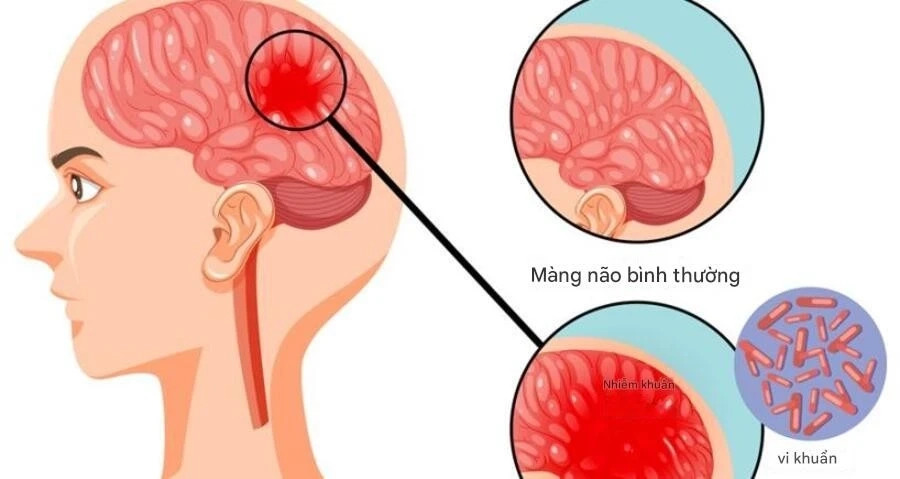 Những điều cần biết về bệnh do não mô cầu Những điều cần biết về bệnh do não mô cầu